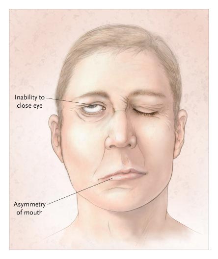 Wajah Menjadi Kurang Menarik Gara-gara Bell's Palsy Wajah Menjadi Kurang Menarik Gara-gara Bell's Palsy
