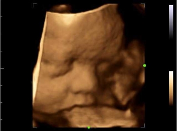 89 Gambar Usg 2 Dimensi Bayi Laki Laki Terlihat Keren