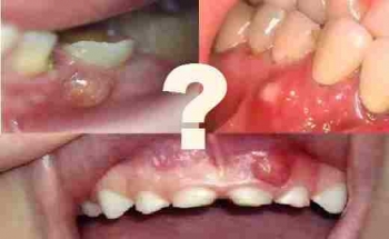 Penyakit Gusi Obat Benjolan di Gusi Ampuh Tidak Ada Di Apotik Alfamart Penyakit Gusi Obat Benjolan di Gusi Ampuh Tidak Ada Di Apotik Alfamart