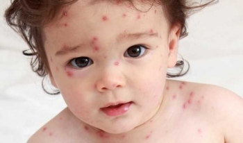 Cara Cepat Sembuhkan Cacar Air dengan Mudah yang Bisa Dicoba Cara Cepat Sembuhkan Cacar Air dengan Mudah yang Bisa Dicoba