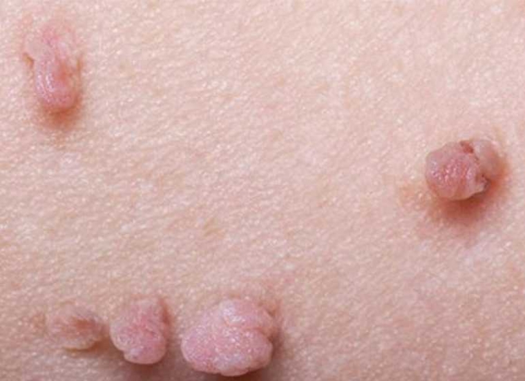 human papillomavirus infection cdc hpv virus pregnancy