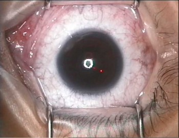 Yang Wajib Anda Tau Dan Diperhatikan Sebelum Operasik Lasik mata