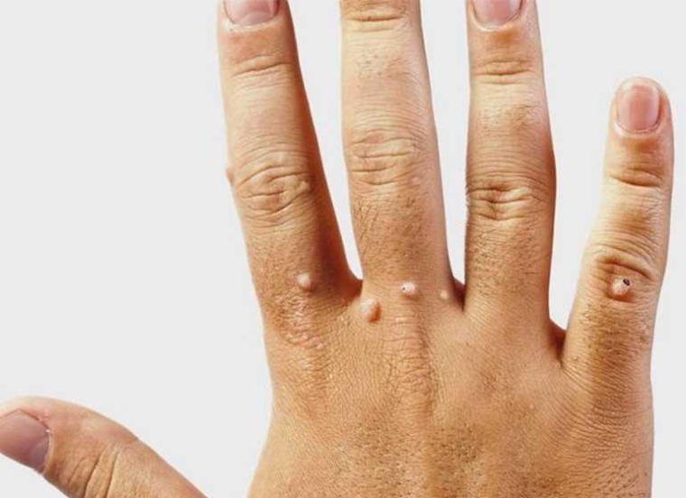 Mengenal Kutil; Definisi, Gejala dan Jenisnya Halaman 1 - Kompasiana.com