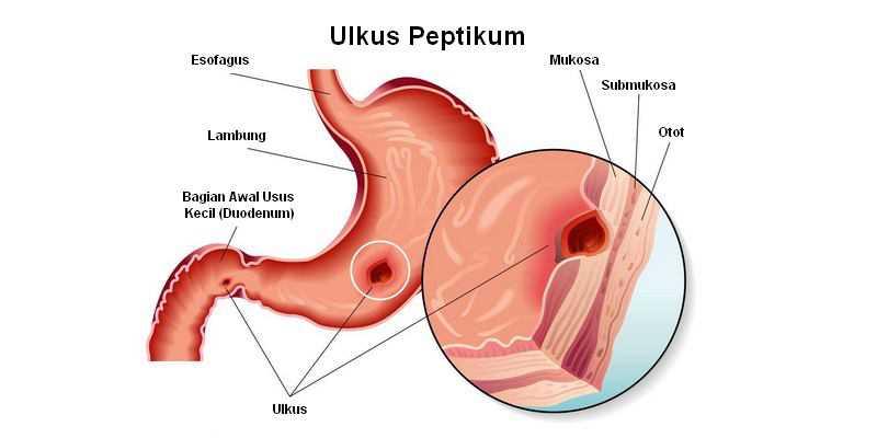 Sakit Maag Tandatanda Penyebab  Mengobati Alodokter