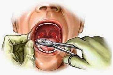 Mengapa Gigi yang Sakit Tidak Boleh Dicabut?