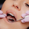Memanfaatkan Fasilitas Scalling Gigi dengan BPJS Kesehatan
