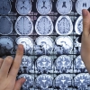 Meningkatkan Kesadaran dan Pencegahan Tumor Otak