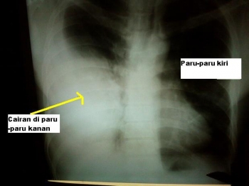 Asap Rokok Papa Berubah Jadi Air Kuning Itu Ya Om Dokter