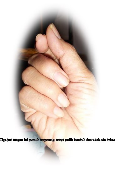 Cara Mengobati Jari Tangan Tercelup Minyak Panas dan Jari Cara Mengobati Jari Tangan Tercelup Minyak Panas dan Jari